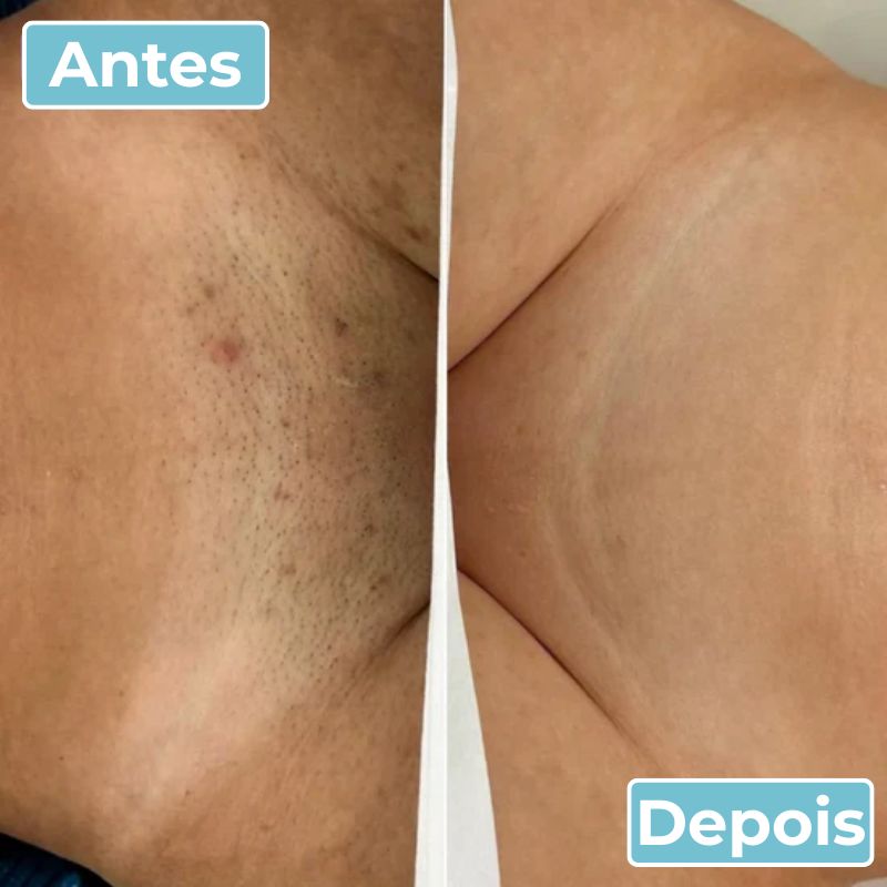 LisoPro™ - Obtenha uma pele suave em segundos