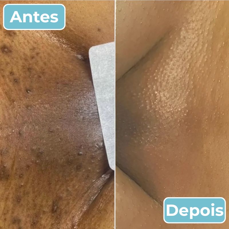 LisoPro™ - Obtenha uma pele suave em segundos